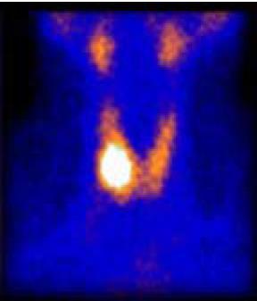 Uso diagnóstico Radioisótopos administrados a pacientes emitem radiação do órgão onde se concentram. Iodo-131 (I -131 ) - emite partícula beta, radiação gama e tem meiavida de oito dias.
