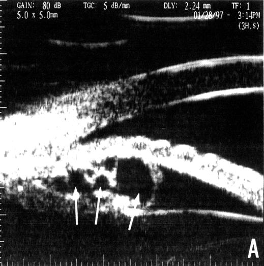 Fig. 3 - Imagem de biomicroscopia ultra-sônica apresentando múltiplos cistos primários de íris (setas). A. incidência longitudinal; B. incidência transversal. plateau.