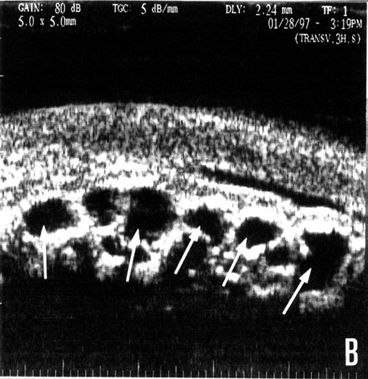 meridianos de 3, 4, 5 e 6; a íris apresentava-se retificada e o corpo ciliar anteriorizado.