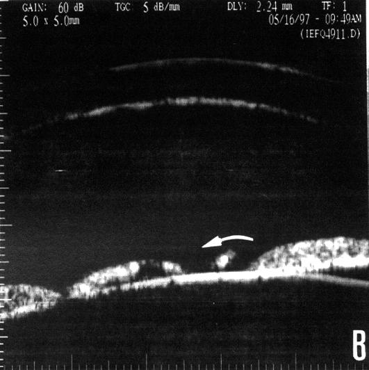 Imagem de biomicroscopia ultra-sônica do caso com diferentes angulações do globo ocular (setas demonstrativas da mobilidade): B. supraversão, C.