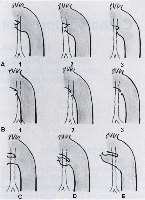 2) CLASSIFICAÇÃO DE KRISHENKO (figura) - Descrito por Mullins: curto com base longa; longo, amplo e cônico; pequeno, cônico e simétrico; pequeno, cônico e assimétrico; longo e tubular; janela.