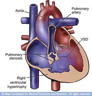 TETRALOGIA DE FALLOT 1) INTRODUÇÃO (DEFINIÇÃO, PREVALÊNCIA, INCIDÊNCIA) - caracterizada por: CIV ampla (80% perimembranosa); dextroposição da aorta (cavalgamento de 5 a 50%); hipertrofia VD