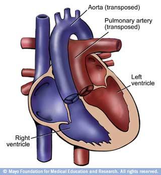 TRANSPOSIÇÃO DAS GRANDES ARTÉRIAS 1) INTRODUÇÃO (DEFINIÇÃO, PREVALÊNCIA, INCIDÊNCIA) - é a cardiopatia congênita cianogênica mais comum ao nascimento - é definida com base nas conexões das grandes