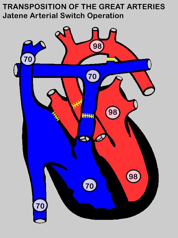 comunicação interventricular - Blalock-Taussig depois Damus-Kaye-Stansel (artéria pulmonar é seccionada, a parte distal fechada com patch e a proximal anastomosada com a