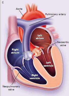 TRANSPOSIÇÃO DAS GRANDES ARTÉRIAS CORRIGIDA 1) INTRODUÇÃO (DEFINIÇÃO, PREVALÊNCIA, INCIDÊNCIA) - 0,05% das cardiopatias congênitas - 5% tem situs inversus, 25% podem ter dextrocardia ou mesocardia -