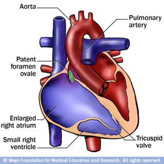 5) ECOCARDIOGRAMA - a primeira dica de L-TGA é um significante mau alinhamento entre o septo interatrial e interventricular - diferenciar lado direito do esquerdo - posição apical da valva do VD em