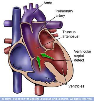 16) CONSIDERAÇÕES - defeitos associados: FOP ou defeito do septo interatrial em 90% dos casos; obstrução da valva pulmonar; alteração do aparelho valvar mitral; CIV; discordância AV; DSAV total ou