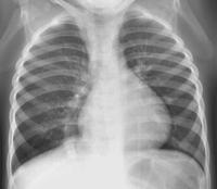 3) FISIOLOGIA - muitos pacientes com os tipos cardíaco e supra cardíaco e quase todos do infra cardíaco tem hipertensão pulmonar secundária à obstrução do retorno venoso pulmonar; seja pelo