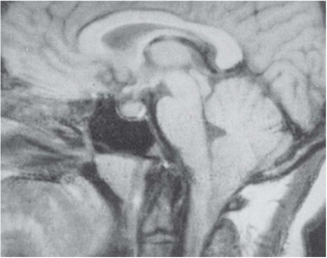 A siringomielia, que é um transtorno crônico progressivo causado por formação de cavidade dentro da medula espinhal, comumente está associada à malformação de Chiari do tipo I, causada pela descida