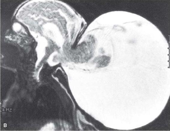 cervical ao nível C3. O quarto ventrículo apresenta-se tipicamente pequeno. Há também agenesia do corpo caloso.