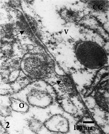 de cromatina condensada (CC). Mitocondrias arredondadas (M) estão aglomeradas ao redor do núcleo 4.250X.