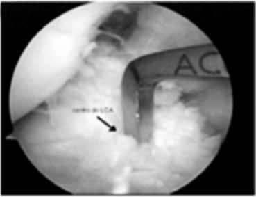 A avaliação do quadrante de apresentação no côndilo femoral foi descrita com uso de frequências absolutas e relativas e foi criado um resultado final dos três avaliadores em