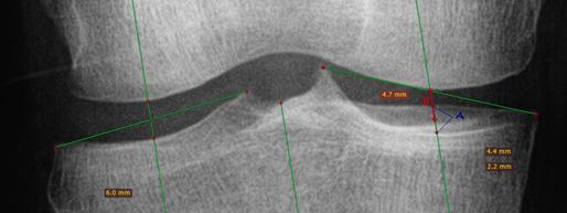 Figura 2. Imagem radiográfica do joelho com exemplo ilustrativo das medições executadas no desdobramento dos pratos tibiais.