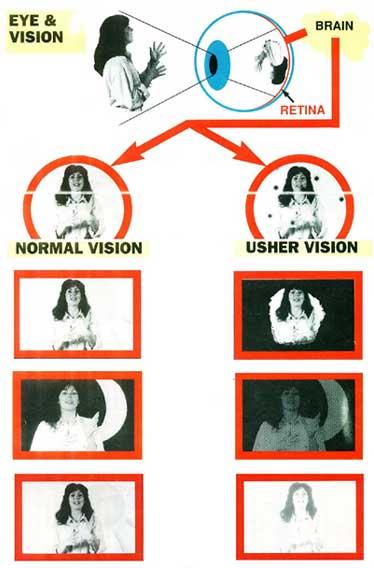 Os sintomas da Síndrome de Usher podem ser melhor compreendidos analisando o paralelo entre a visão normal e a visão Usher exemplificado pela fig.1. Fig.