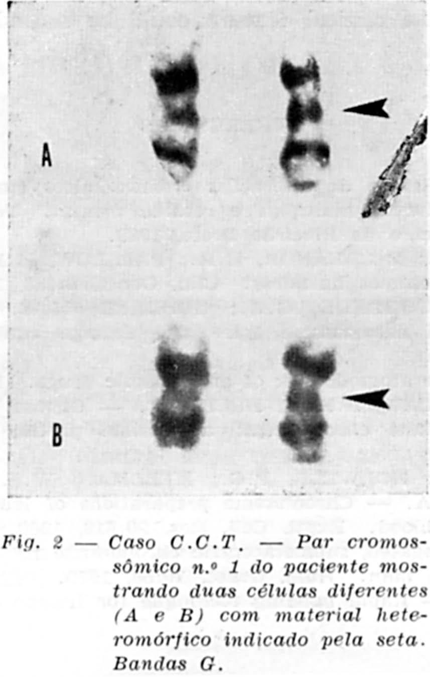 A análise cromossômica do paciente e três familiares revelou igualmente em todos, aumento do braço longo do cromossomo n. 1.