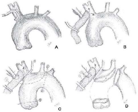 (250ml/min a 350ml/min). Kazui et al.