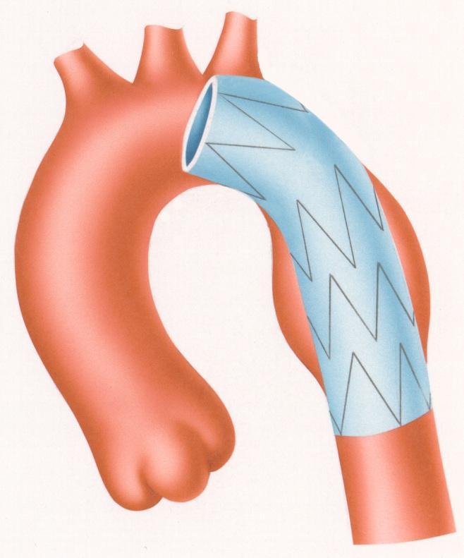 A B Figura 23 - O mau posicionamento no arco da aorta pode provocar um mecanismo de válvula,