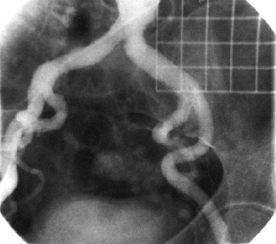 Figura 4 A arteriografia permite visibilizar a intensa tortuosidade das artérias ilíacas que, a direita,