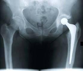 Artroplastia Total Prótese total cimentada 1 1. Componente acetabular de polietileno 2.