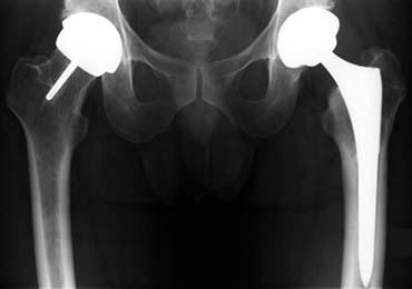 51 - total hip replacement (Not specified) + 00.75 - hip bearing surface M/M 00.