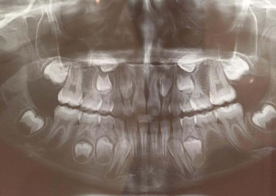 7 2 REVISÃO DE LITERATURA 2.1 CLASSIFICAÇÃO Variações no número de dentes em desenvolvimento são comuns. Diversos termos são úteis na discussão das variações numéricas dos dentes.