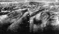 Imagem hipoecóica e mal delimitada na fossa ilíaca direita, medindo aproximadamente 3 cm no maior diâmetro. Figura 9. Paciente do sexo masculino, 27 anos de idade.