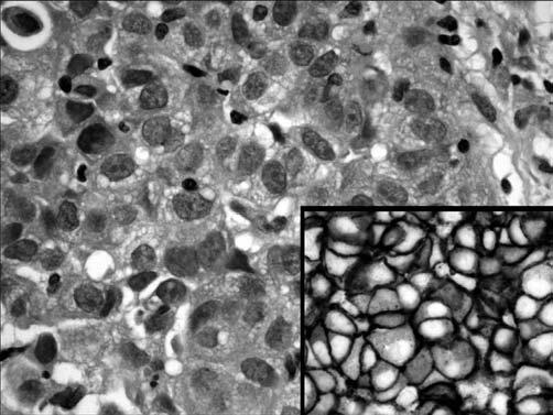 proteico do oncogene HER-2 Origem do anticorpo primário/ Clone ou designação/ Fonte comercial/diluição Anticorpo monoclonal de coelho; Clone SP1/Neomarkers (EUA)/1:500 Anticorpo monoclonal de