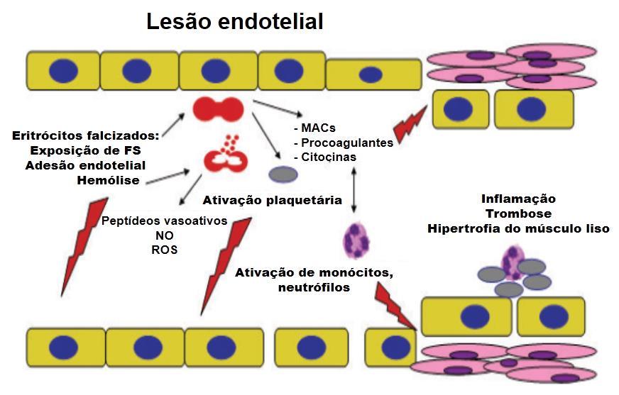 25 Figura 2. Fisiopatogenia da doença cerebrovascular na doença falciforme.