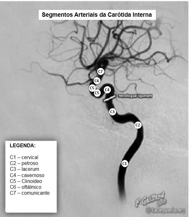 30 Figura 4. Angiografia mostrando o curso da artéria carótida interna intracraniana (Adaptado de FRANK GAILLARD, 2008)