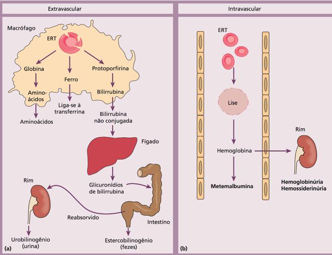 TIPOS DE HEMÓLISES HEMÓLISE EXTRAVASCULAR!