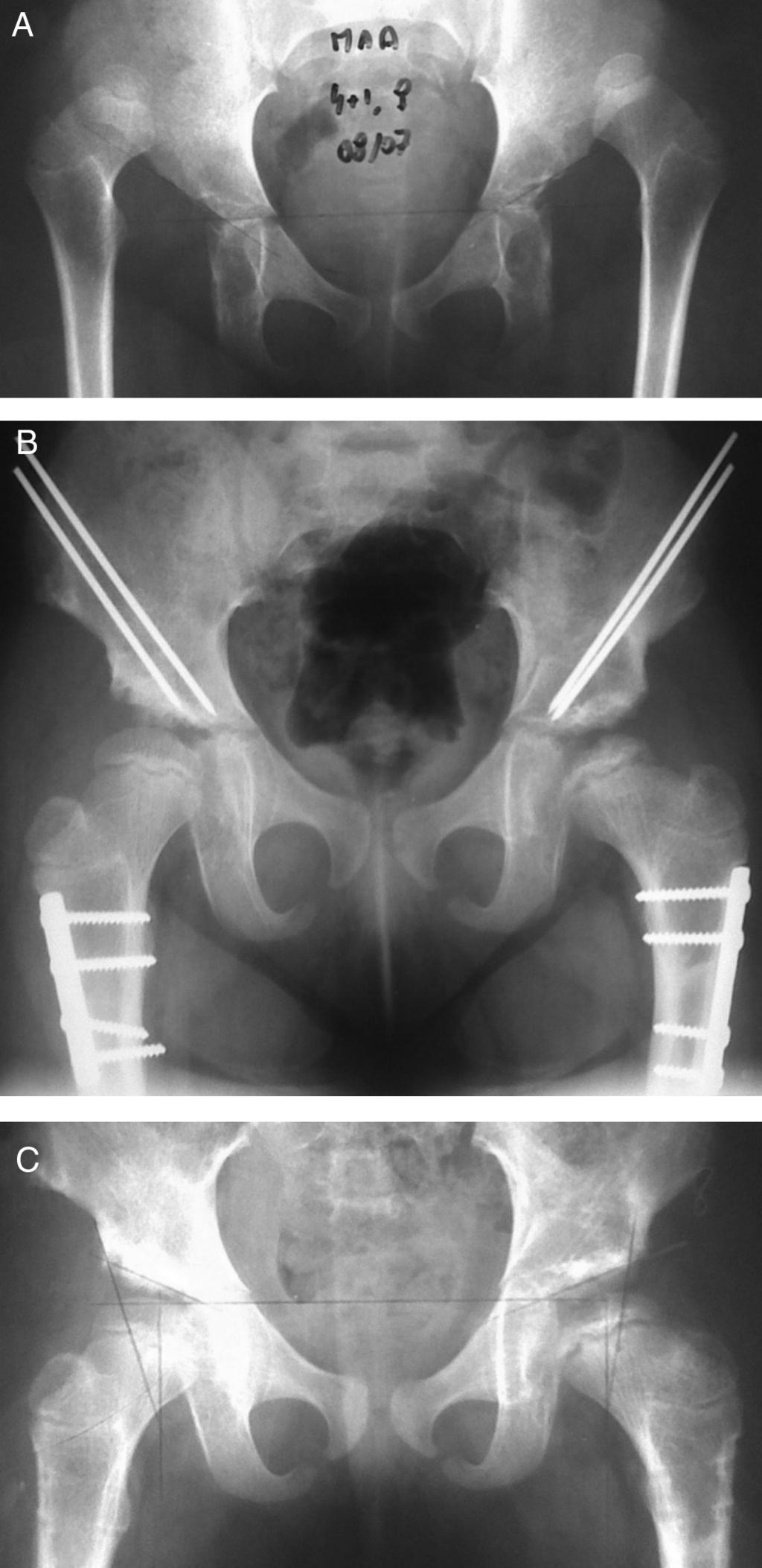 352 rev bras ortop. 2014;49(4):350 358 analisados apenas os casos com acometimento bilateral tratados por meio de redução cruenta e osteotomia de Salter com ou sem encurtamento femoral de Ombrédanne.