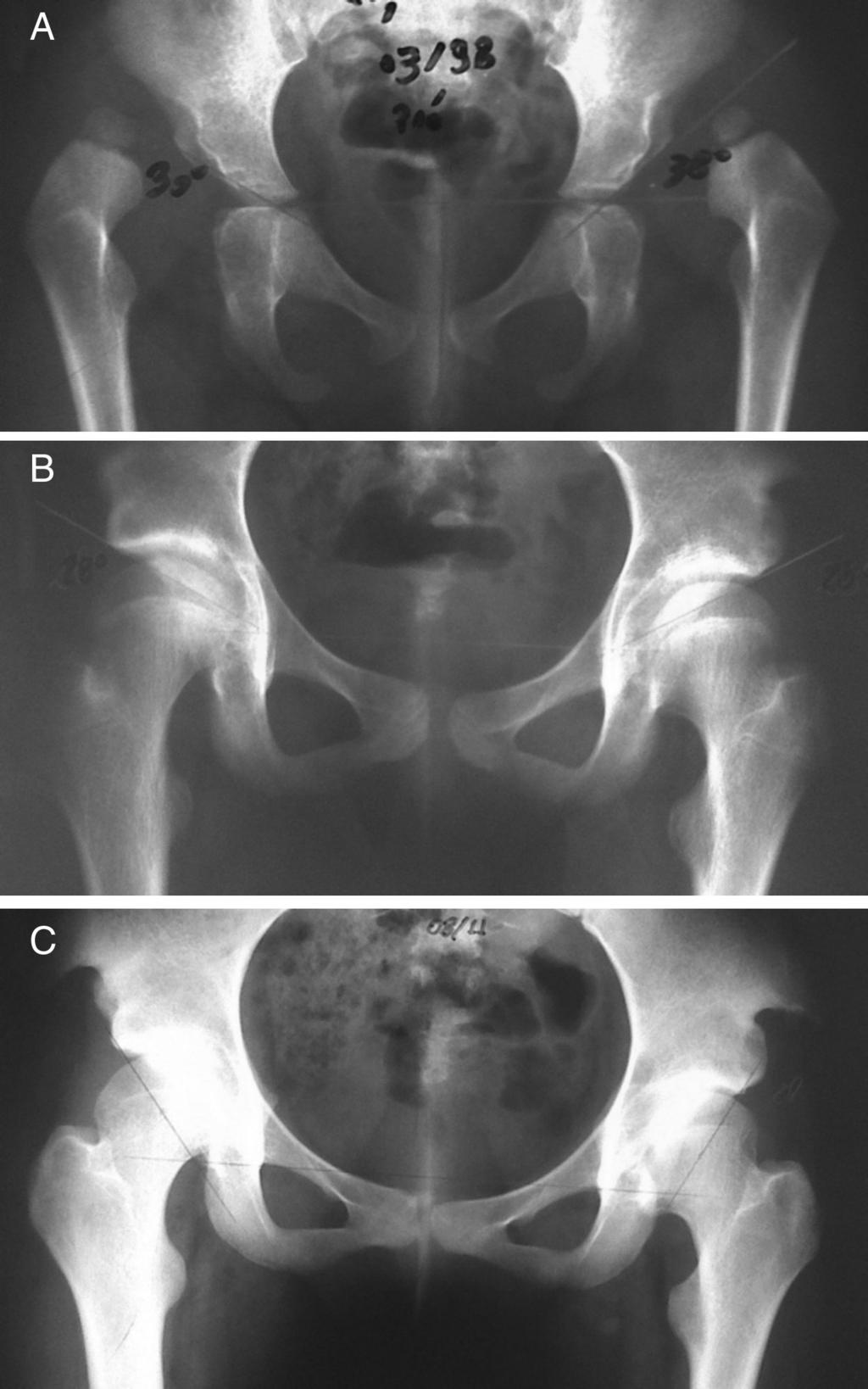 (C) Rx de 10/2011, pós-operatório tardio de sete anos do quadril direito e seis anos e nove meses do quadril esquerdo, que apresenta necrose tipo 4 da cabeça femoral.