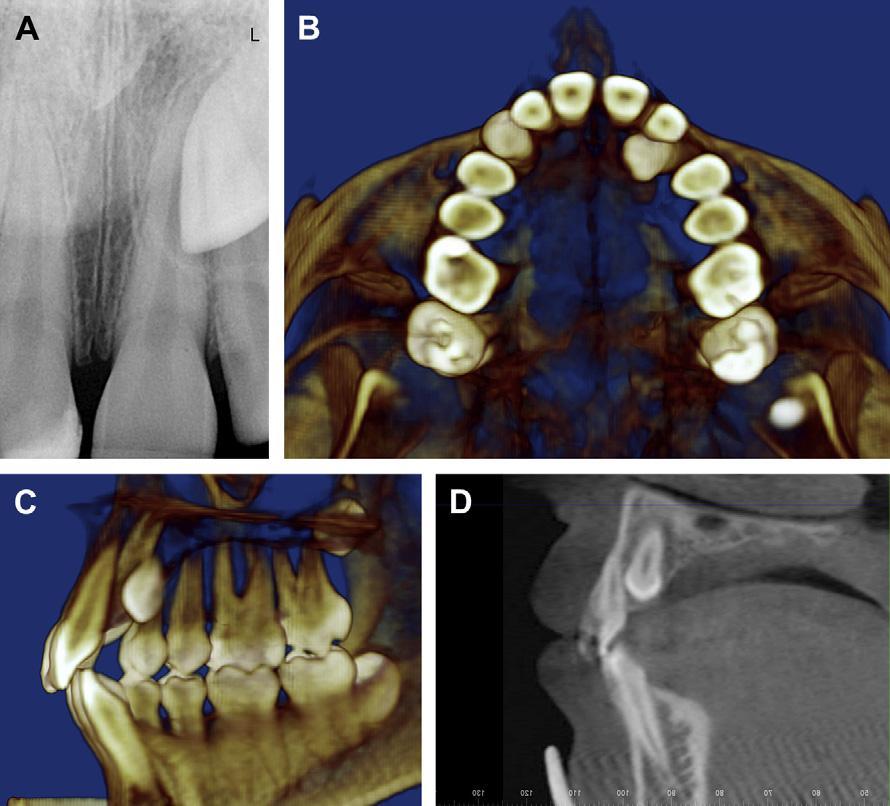 Figura 3 (A) Radiografia periapical mostrando um dente 23 impactado. (B) Imagem axial de TCFC mostrando a posição palatina do dente 23. (C) Imagem de TCFC da relação entre os dentes 21 e 23.