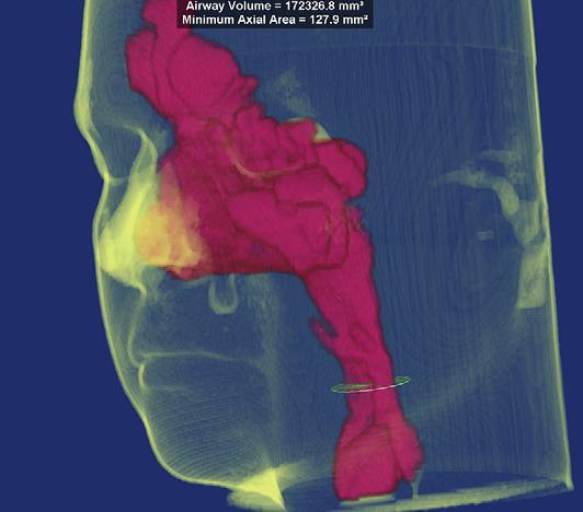 Ortodontistas que estão particularmente interessados em estudar as vias aéreas do doente, certamente irão continuar a reforçar as análises que estão disponíveis usando as informações em 3D. (24) Fig.