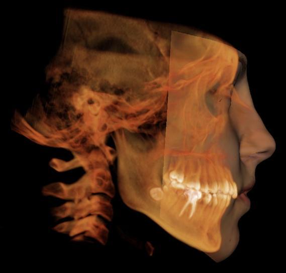 Fig. 7 - Fotos faciais sobrepostas sobre uma renderização volumétrica 3D do esqueleto. Mapeamento nodal e esterofotogrametria permitem que as fotos sejam visualizadas e manipuladas em 3D.