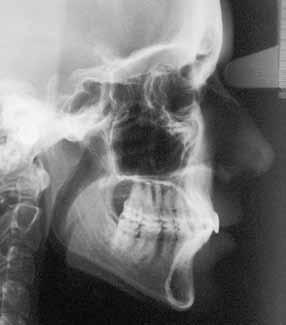 A B C Fig. 8 (A) Telerradiografia de perfil. (B) Imagem obtida através de TCFC, em norma lateral, em 2D. (C) Imagem obtida através de TCFC em norma lateral, em 3D. (Couceiro CP.