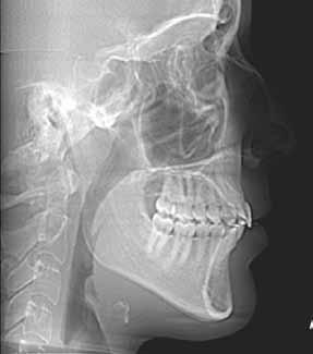 2010;15(5):8) Quando devemos requisitar uma tomografia computadorizada de feixe cónico em Ortodontia? Critérios para solicitação de TCFC estão ainda a ser estabelecidos.