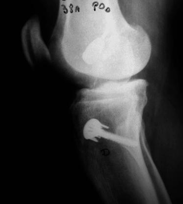 46 Caso 2: Paciente N 16: Radiografias joelho