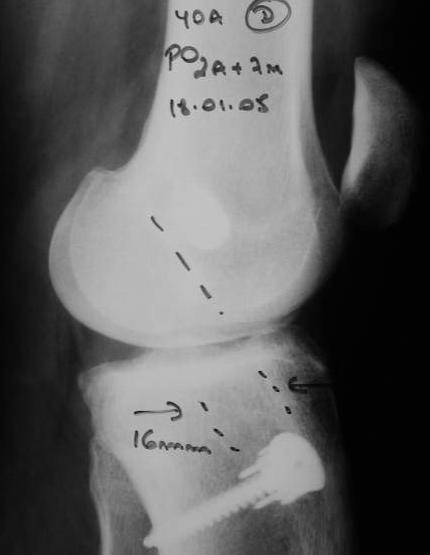 Paciente N 16: Radiografias joelho D (AP + P)