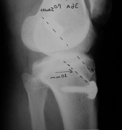 mm). Paciente N 28: Radiografias joelho D