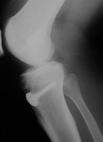 49 Caso 5: Paciente N 46: Radiografias joelho D (AP + P) no Po imediato (broca 7
