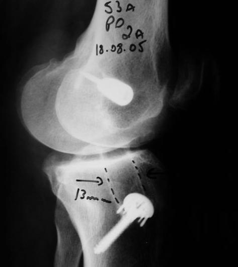 mm). Paciente N 49: Radiografias joelho E