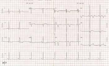 ECG com sistoles prematuras ventriculares com padrão de BCRE (origem no VD). Avaliação subsequente foi normal. de MS antes dos 35 anos, ou doença não confirmada em familiares até ao 3.
