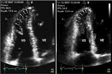 Figura 7 Ecocardiograma (apical-4 cam) de atleta com MAVD, em que é possível observar aneurisma localizado no apex VD de imagem de primeira linha na avaliação morfológica e funcional do VD, não