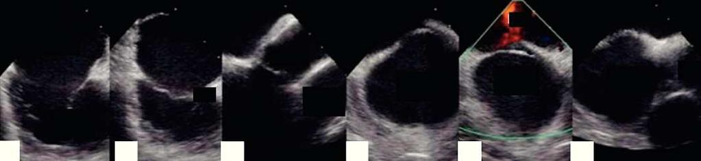 Encerramento percutâneo de defeitos do septo interauricular guiado por ecocardiograma intracardíaco 409 VT TSVD VD VD 1 2 3 4 5 6 Figura 1 Incidências obtidas por ecocardiograma intracardíaco em