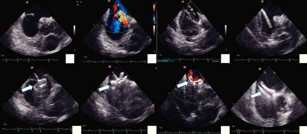 410 L. Seca et al. CIA AP 1 2 3 4 5 6 7 8 Figura 2 Encerramento de CIA monitorizada por ecocardiograma intracardíaco.