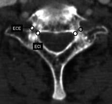 Morfometria dos pedículos de C7 avaliados por tomografia computadorizada axial 187 para o estudo foram os cortes axiais que demonstravam as maiores dimensões do pedículo de C7 para cada lado.