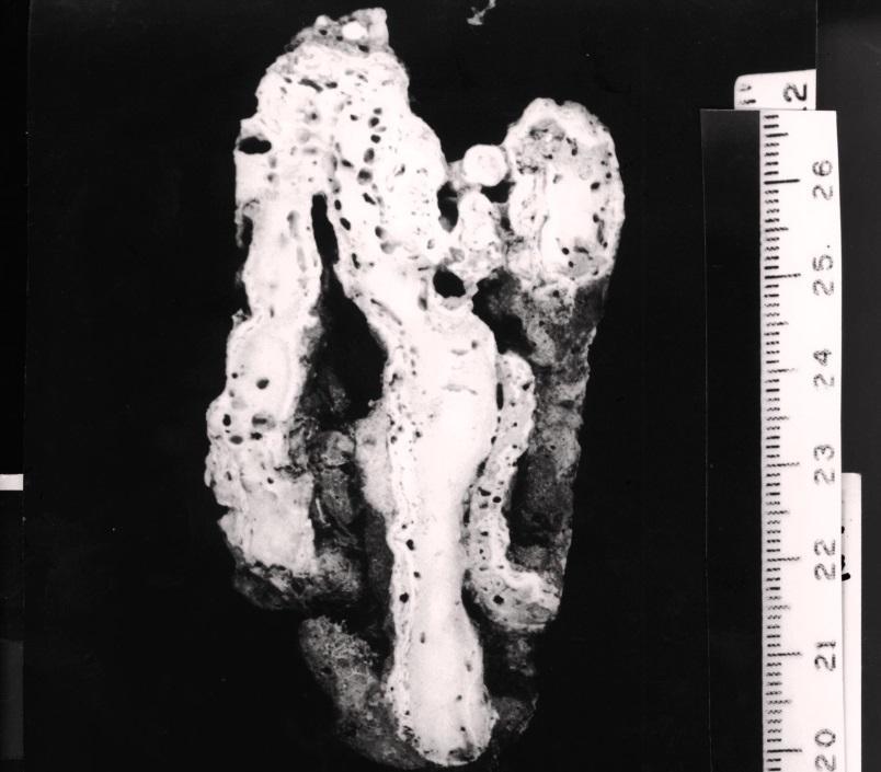 Nesta seção os fragmentos de Millepora estão incrustados com camada fina de alga coralina, como pode ser melhor obsevado na foto de detalhe da figura 33 B. Figura 33 A.