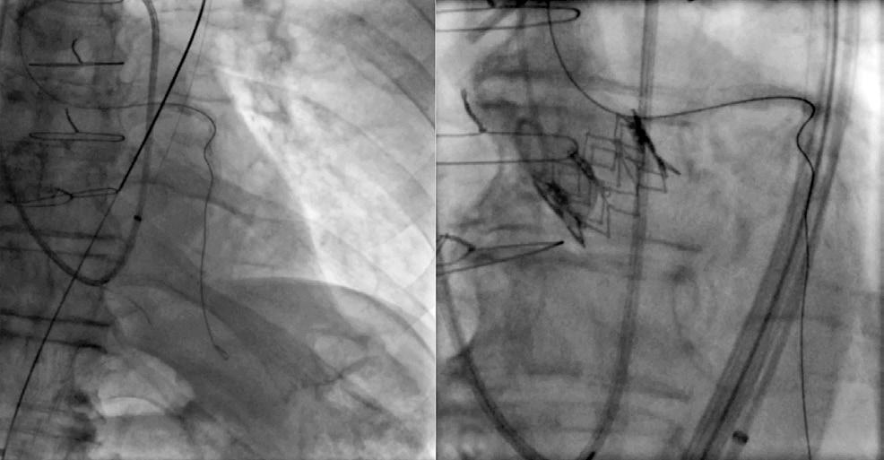 Rev Bras Cardiol Invasiva. 317 A B Figura 2.