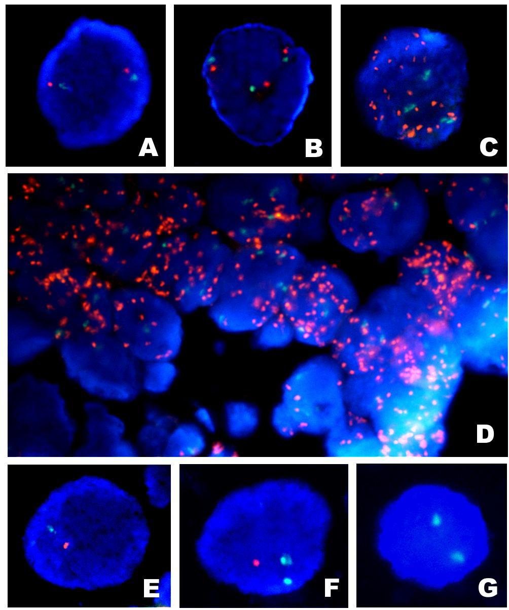 Figura 6. Foto (filtro triplo) da hibridização in situ das células tumorais usando as sondas LSI EGFR/CEP7 e a LSI PTEN/CEP10.